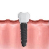 видове зъбни импланти - 65375 отстъпки