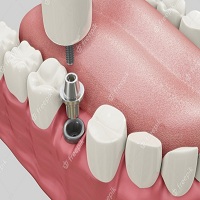 видове зъбни импланти - 64075 снимки