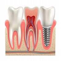 видове зъбни импланти - 45879 отстъпки