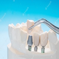видове зъбни импланти - 39330 постижения