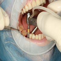 видове зъбни импланти - 70194 снимки