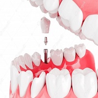 видове зъбни импланти - 80352 предложения